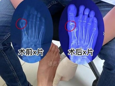 探究以6个脚趾头手术所需的时间（一项关乎手术时长的神秘医学技术）